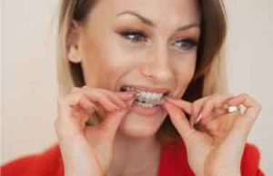 invisible teeth aligners cheap
